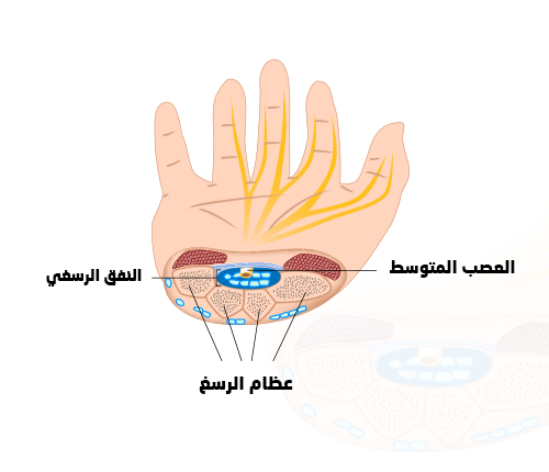  متلازمة النفق الرسغي